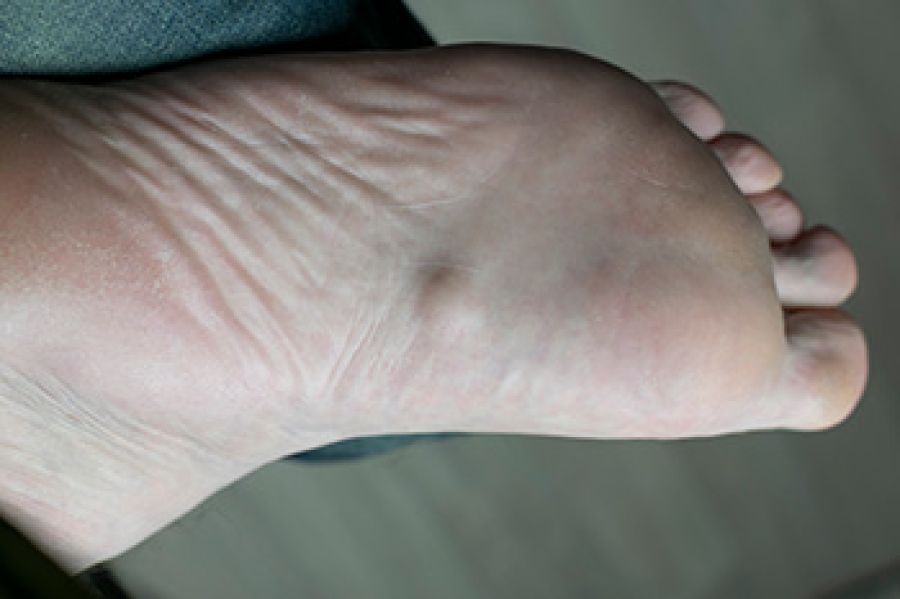 Nodules on the Sole of the Foot